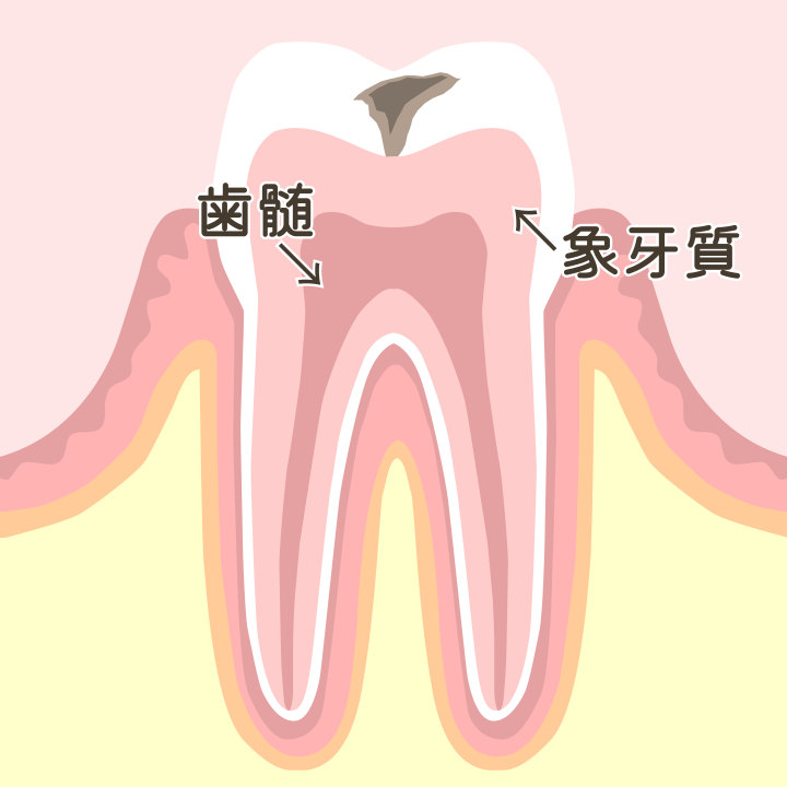 進行段階：C2（象牙質の虫歯）