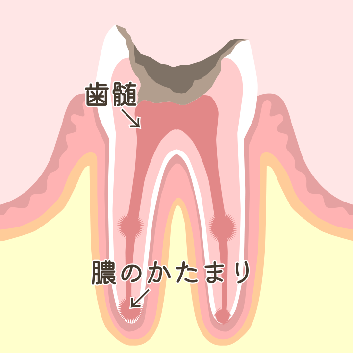 進行段階：C4（歯根まで達した虫歯）